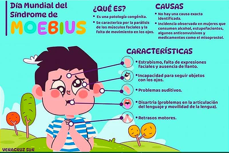 ¡DÍA MUNDIAL DEL SÍNDROME DE MOEBIUS! -PATOLOGÍA CARACTERIZADA POR UNA PARÁLISIS DE LOS MÚSCULOS FACIALES Y FALTA DE MOVIMIENTO EN LOS OJOS...