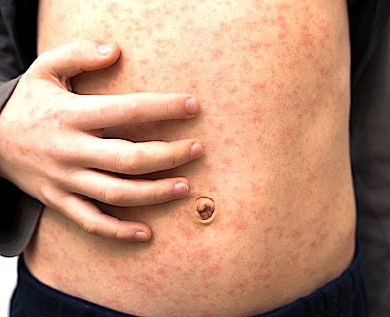 ¡PRENDEN LA ALERTA POR EL SARAMPIÓN!