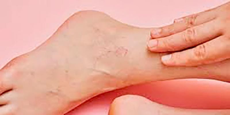 TIPS PARA MEJORAR TU CALIDAD DE VIDA | VÁRICES - Las várices, también conocidas como venas varicosas, son venas dilatadas que se hinchan y se retuercen, generalmente visibles bajo la piel, y a menudo aparecen en las piernas...