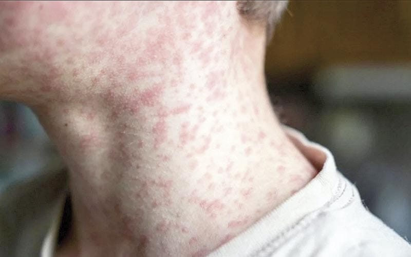 ¡SSA CONFIRMA 17 MUERTES POR SARAMPIÓN EN MÉXICO!