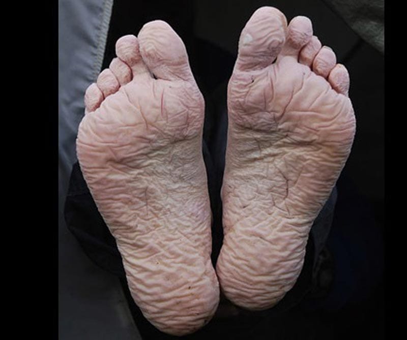 ¡ALERTA IMSS POR PIE TRINCHERA!