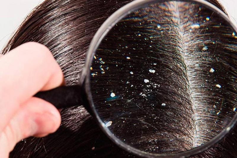 TIPS PARA MEJORAR TU CALIDAD DE VIDA | LA CASPA. 2 PARTE - La insuficiente actividad de éstas o, por el contrario, la sobreproducción, pueden crear descamación cutánea, así como cabello quebradizo o graso, respectivamente...