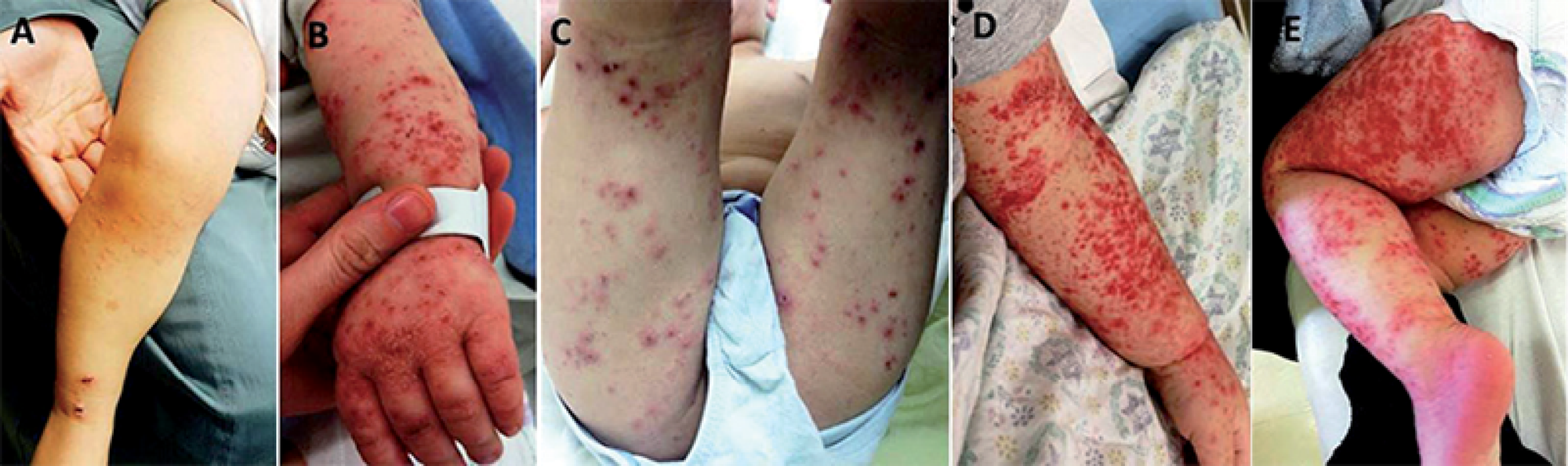 ¡ATACA EL VIRUS COXSACKIE!