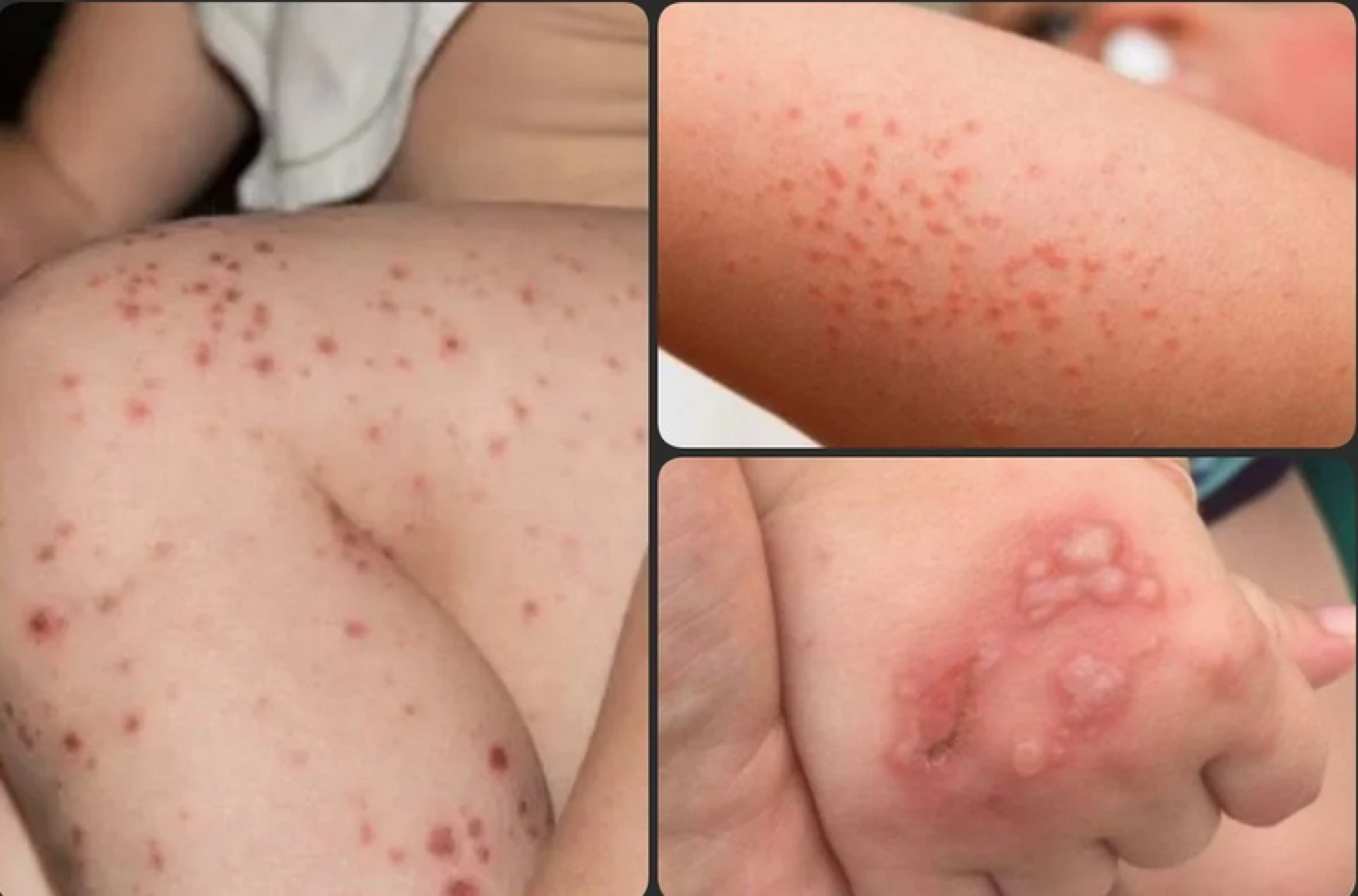 ¡SE DISPARA EL BROTE DE COXSACKLE!