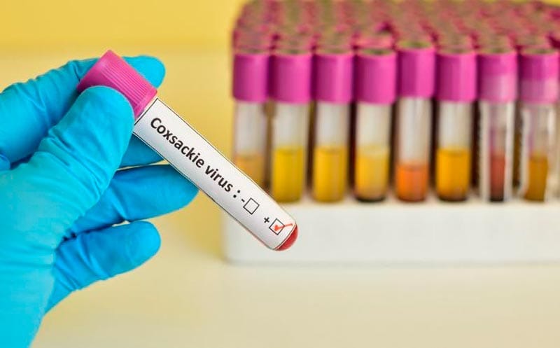 ¡VIRUS COXSACKIE EN VERACRUZ! - *Hay 71 casos atendidos en escuelas