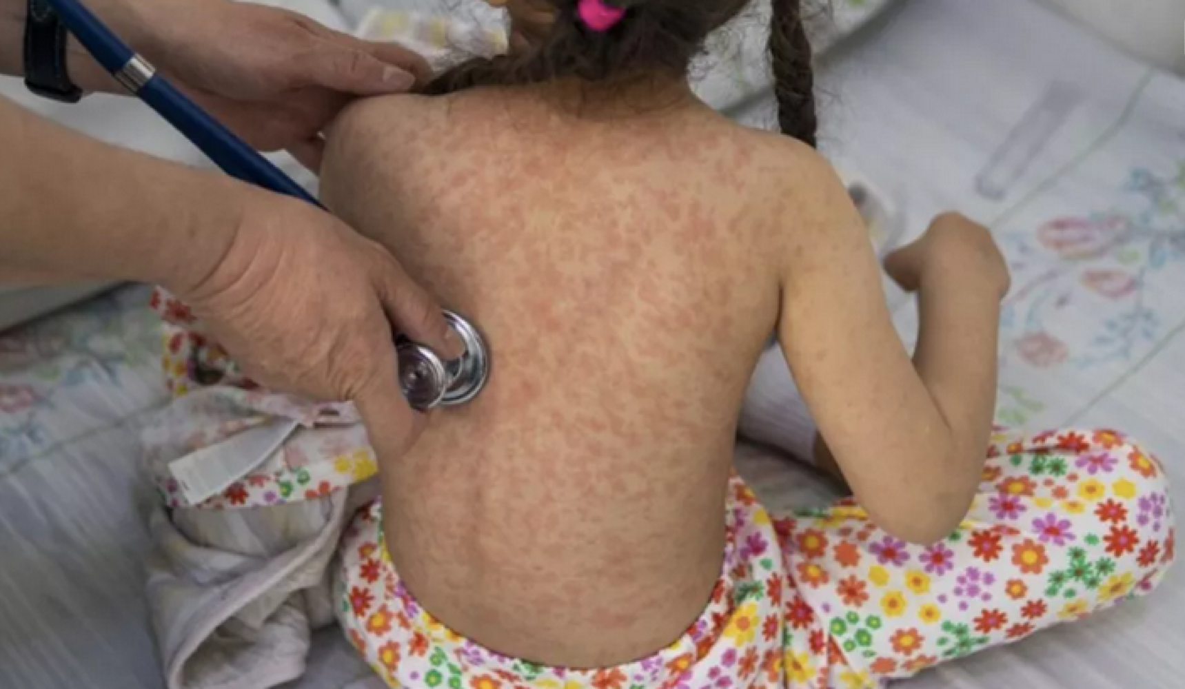 SIN CONTROL! El Sarampión