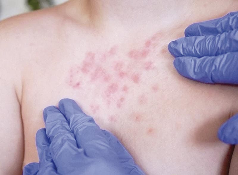 ¡REGISTRA MÉXICO MÁS DE 9 MIL CASOS DE SARAMPIÓN!