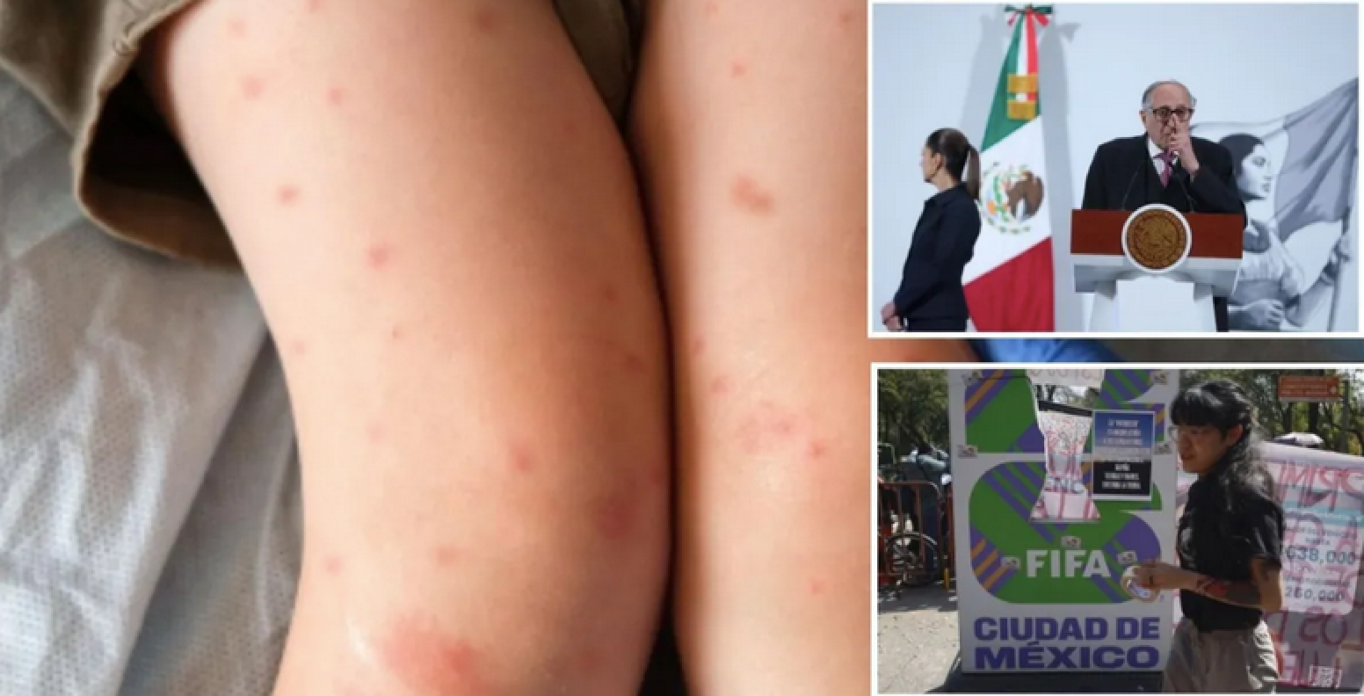 ¡ACELERAN VACUNACIÓN CONTRA LA SARAMPIÓN!