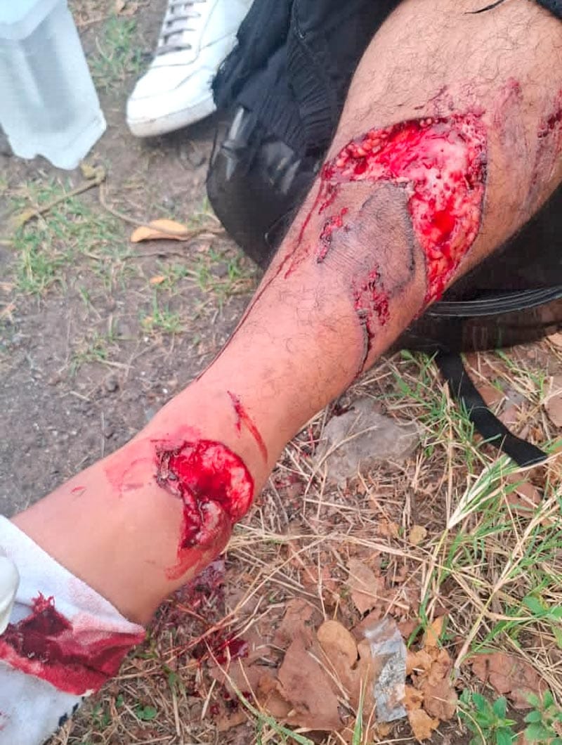 ¡MOTOCICLISTA SE REBANA LA PIERNA EN DERRAPÓN!