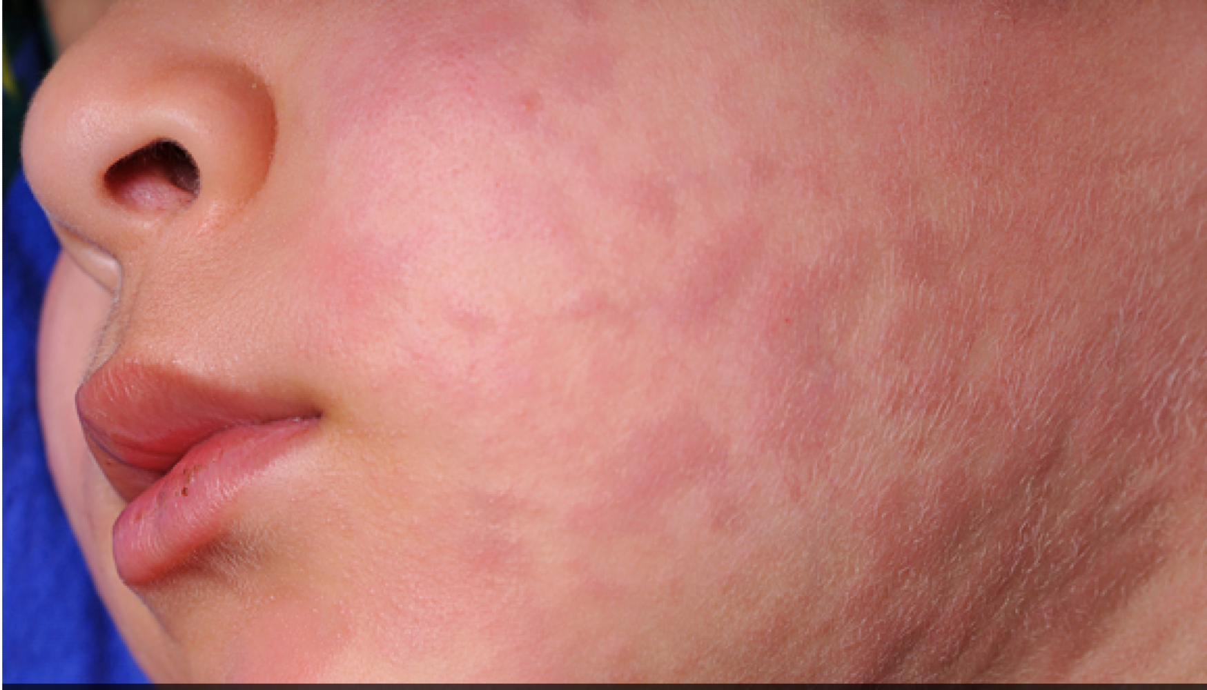 ¡“EL SARAMPIÓN ESTÁ RESURGIENDO CON FUERZA. NO ESTAMOS PREPARADOS”!