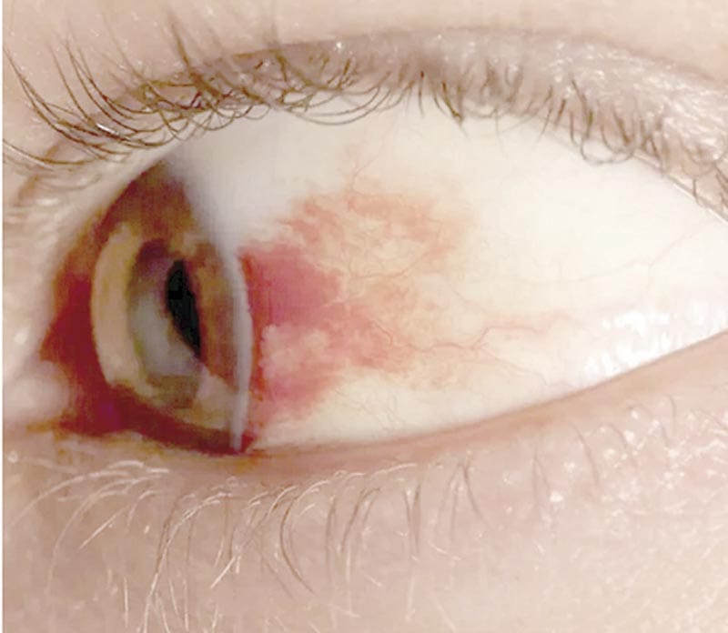 ¡UNAM DESARROLLA GOTAS CONTRA LA CEGUERA POR DIABETES!