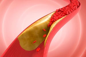 TIPS PARA MEJORAR TU CALIDAD DE VIDA | ATEROESCLEROSIS (PARTE 2)