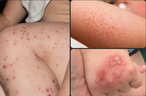 ¡SE DISPARA EL BROTE DE COXSACKLE!