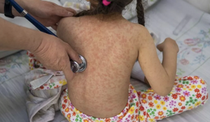 SIN CONTROL! El Sarampión