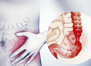 ¡ORIENTA IMSS VERACRUZ NORTE SOBRE PREVENCIÓN DEL SÍNDROME DEL INTESTINO IRRITABLE!
