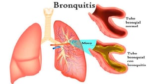 TIPS PARA MEJORAR LA CALIDAD DE VIDA | BRONQUITIS - La bronquitis aguda es la inflamación del árbol traqueobronquial, comúnmente después de una infección de las vías aéreas superiores, en ausencia de trastornos pulmonares…