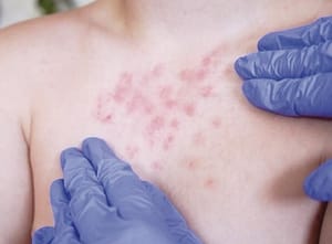 ¡REGISTRA MÉXICO MÁS DE 9 MIL CASOS DE SARAMPIÓN!