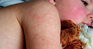 ¡YA SON 21! - *Casos de sarampión