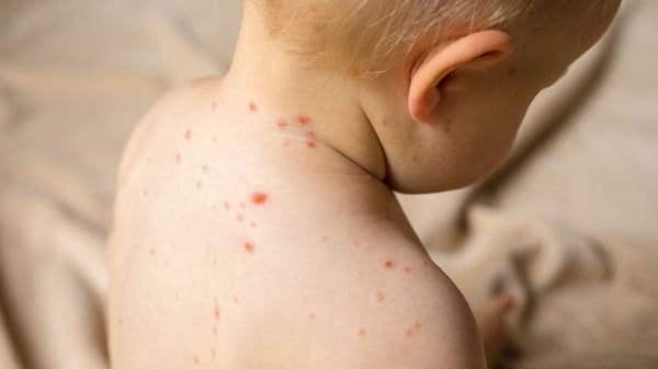 ¡ALERTAN POR ENFERMEDAD DE MANOS, PIE Y BOCA!