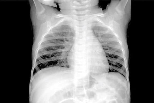 ¡CONFIRMAN UN CASO DE HMPV EN CHIHUAHUA!