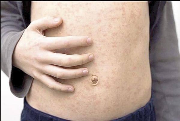 ¡EL PEOR BROTE DE SARAMPIÓN DE LAS ÚLTIMAS TRES DÉCADAS EN TEXAS DEJA YA 90 CASOS!