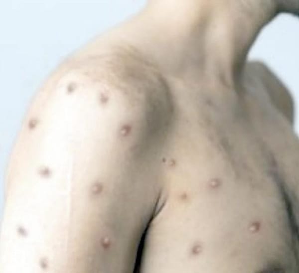 ¡LA OMS SUBRAYA QUE EL MPOX SIGUE SIENDO UNA EMERGENCIA DE SALUD PÚBLICA DE PREOCUPACIÓN INTERNACIONAL!