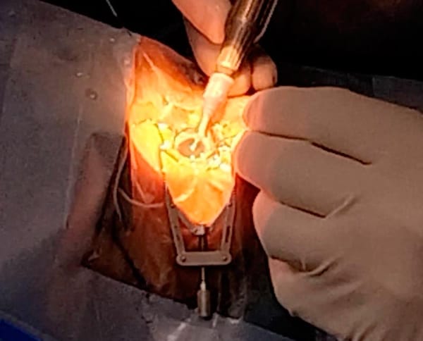 ¡LLEVARÁ IMSS VERACRUZ NORTE A CABO UNA DOBLE JORNADA QUIRÚRGICA DE CATARATAS EN HGZ NO. 11 DE XALAPA!