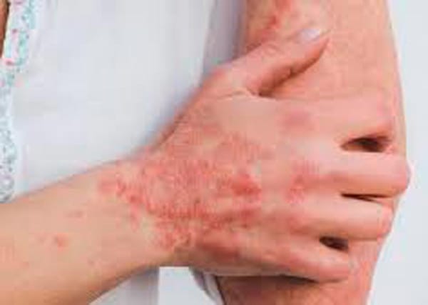 TIPS PARA MEJORAR LA CALIDAD DE VIDA | LA SARNA 1 - Una gran parte de los parásitos cutáneos son diminutos insectos o gusanos que se esconden dentro de la piel, haciendo de ella su hábitat natural. Algunos de estos parásitos viven...