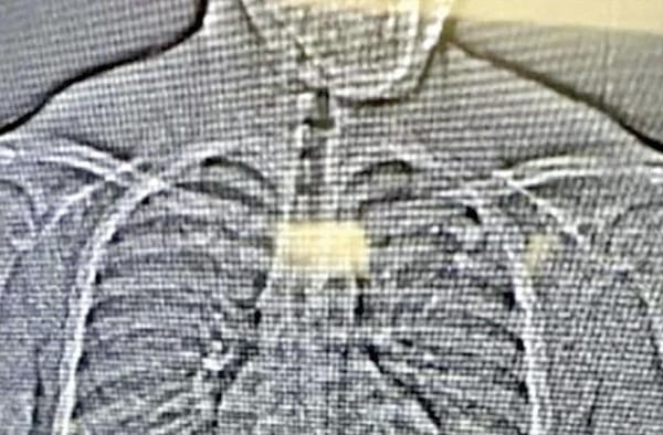 ¡LADRÓN SE TRAGÓ DIAMANTES DE 770 MIL DÓLARES DURANTE SU ARRESTO EN FLORIDA!