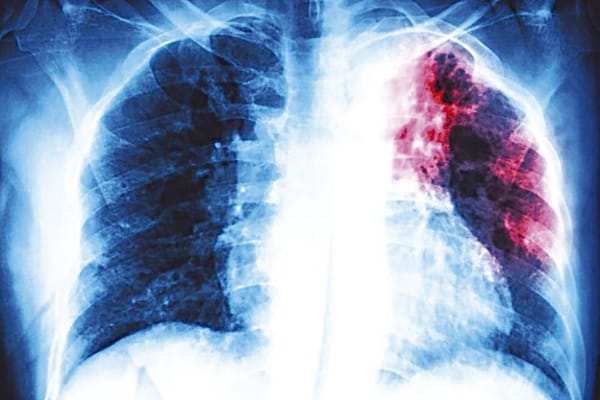 ¡VAN 434 CASOS DE TUBERCULOSIS EN VERACRUZ!