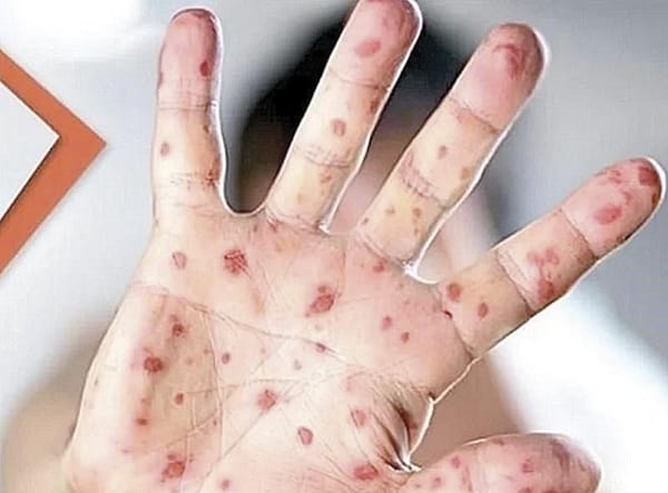 ¡SE EXTIENDE SARAMPIÓN A 17 ESTADOS!