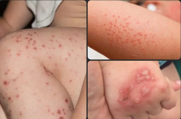 ¡SE DISPARA EL BROTE DE COXSACKLE!