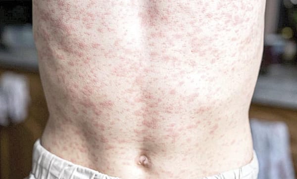 ¡ALERTA A OPS EL BROTE DE SARAMPIÓN EN MÉXICO!