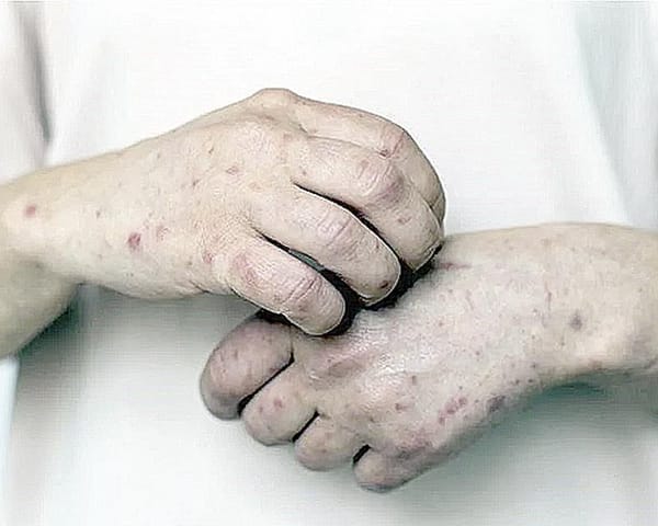 ¡REGISTRA TODO MÉXICO BROTES DE SARAMPIÓN!