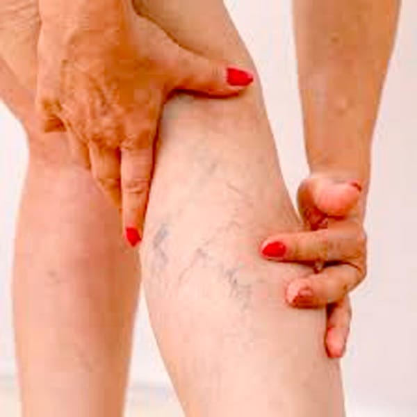 TIPS PARA MEJORAR LA CALIDAD DE VIDA | VARICES - Las várices, también conocidas como venas varicosas, son venas dilatadas que se hinchan y se retuercen, generalmente visibles bajo la piel, y a menudo aparecen en las piernas. Pueden causar dolor…