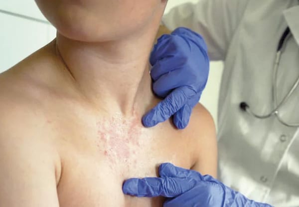 ¡MÉXICO ACUMULA 71% DE SARAMPIÓN! - EN AMERICA