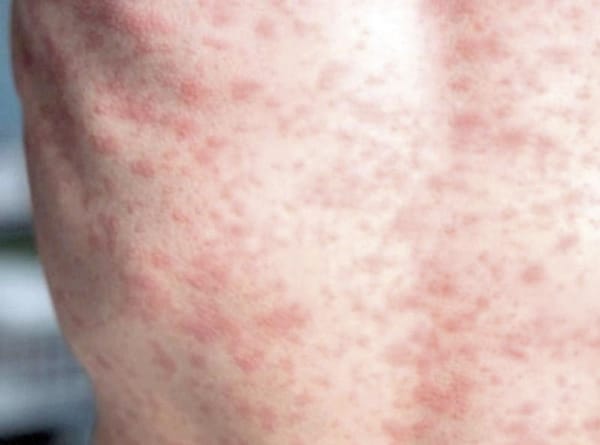 ¡JALISCO CONCENTRA 56% DE CASOS DE SARAMPIÓN EN MÉXICO!