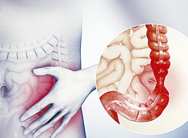 ¡ORIENTA IMSS VERACRUZ NORTE SOBRE PREVENCIÓN DEL SÍNDROME DEL INTESTINO IRRITABLE!