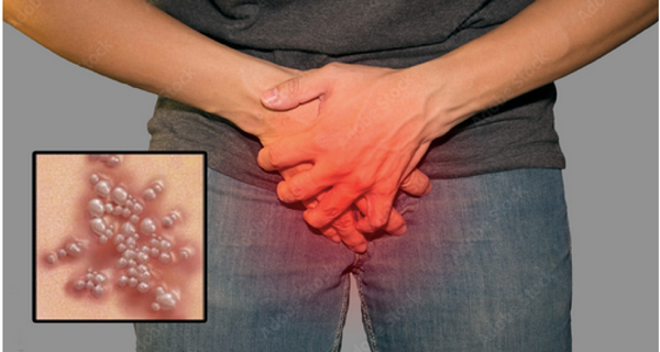 ¡HAY QUE CUIDARSE DEL HERPES GENITAL!