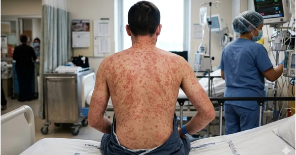 ¡QUE SE REDUJO UN 30% CASOS DE SARAMPIÓN!