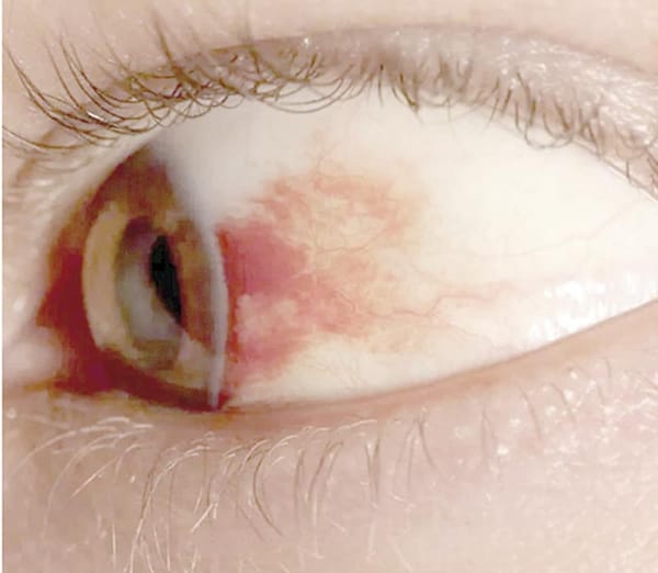 ¡UNAM DESARROLLA GOTAS CONTRA LA CEGUERA POR DIABETES!